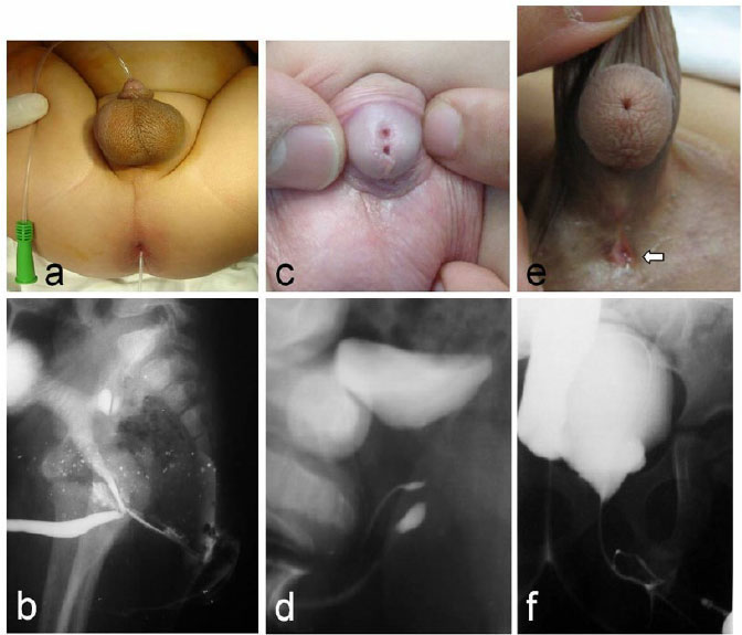 Duplex Urethra Urethrograms